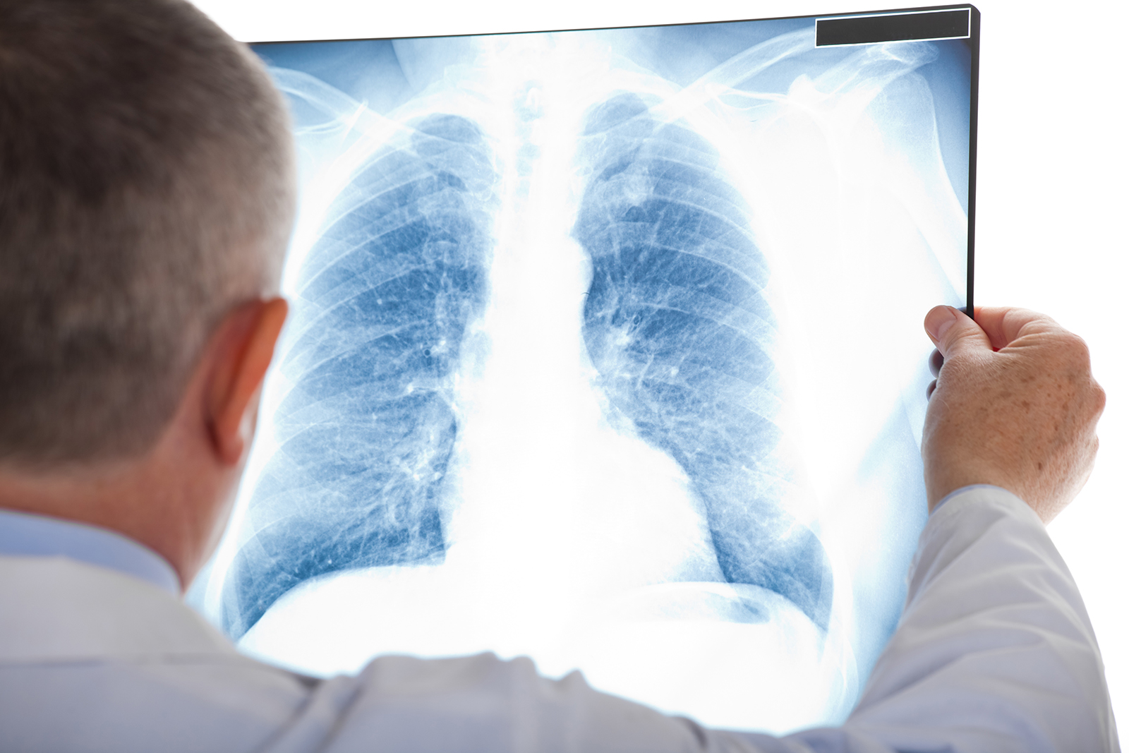 doctor reviewing x-ray of patients lung